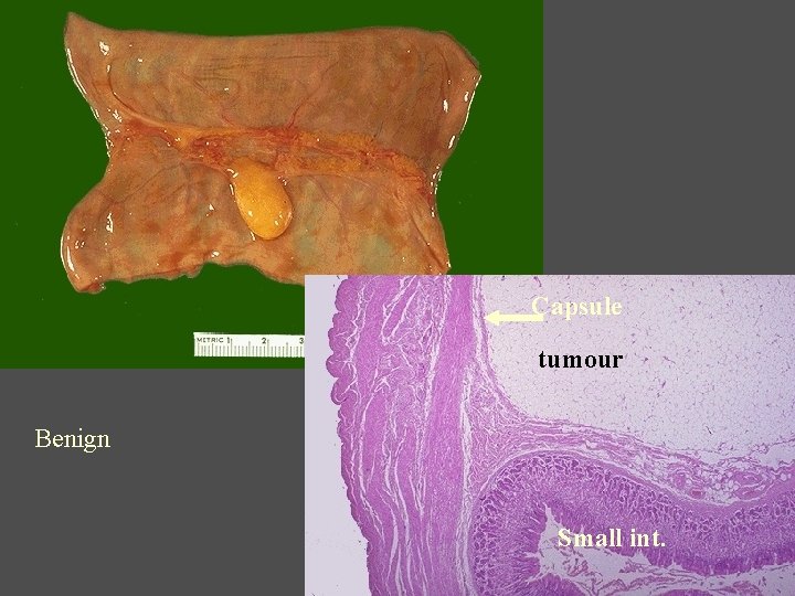 Capsule tumour Benign Small int. 