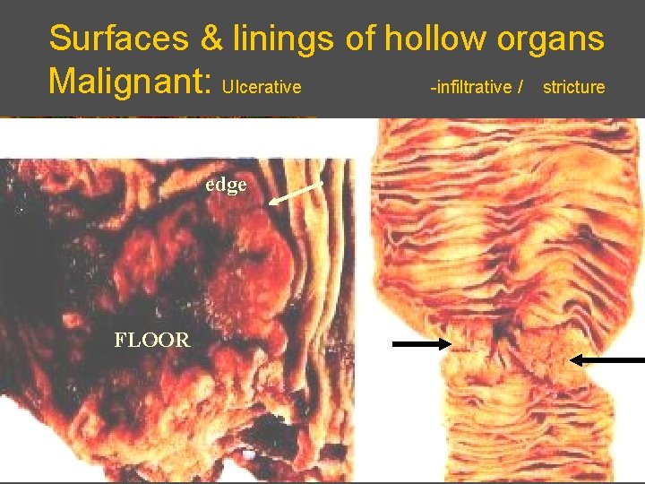 Surfaces & linings of hollow organs Malignant: Ulcerative -infiltrative / stricture edge FLOOR 
