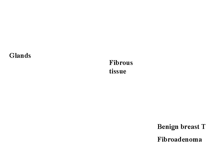 Glands Fibrous tissue Benign breast T Fibroadenoma 