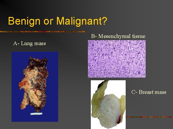 Benign or Malignant? B- Mesenchymal tissue A- Lung mass C- Breast mass 