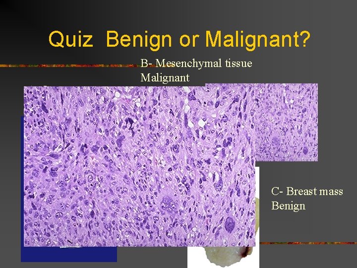 Quiz Benign or Malignant? A- Lung mass Malignant B- Mesenchymal tissue Malignant C- Breast