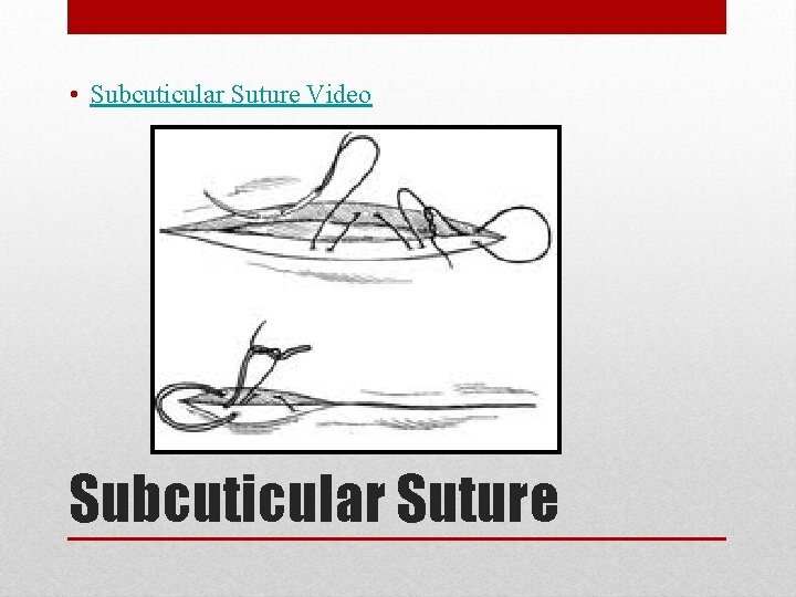  • Subcuticular Suture Video Subcuticular Suture 