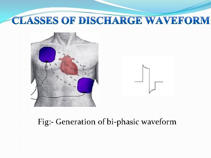 Fig: - Generation of bi-phasic waveform  Fig: - Generation of bi-phasic waveform