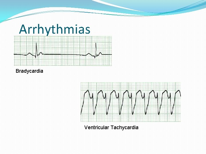 Arrhythmias Bradycardia Ventricular Tachycardia  Arrhythmias Bradycardia Ventricular Tachycardia