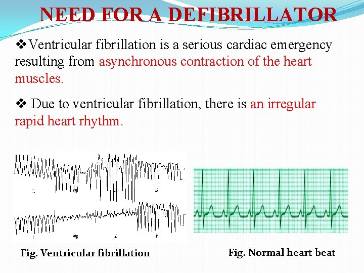 NEED FOR A DEFIBRILLATOR v. Ventricular fibrillation is a serious cardiac emergency resulting from NEED FOR A DEFIBRILLATOR v. Ventricular fibrillation is a serious cardiac emergency resulting from