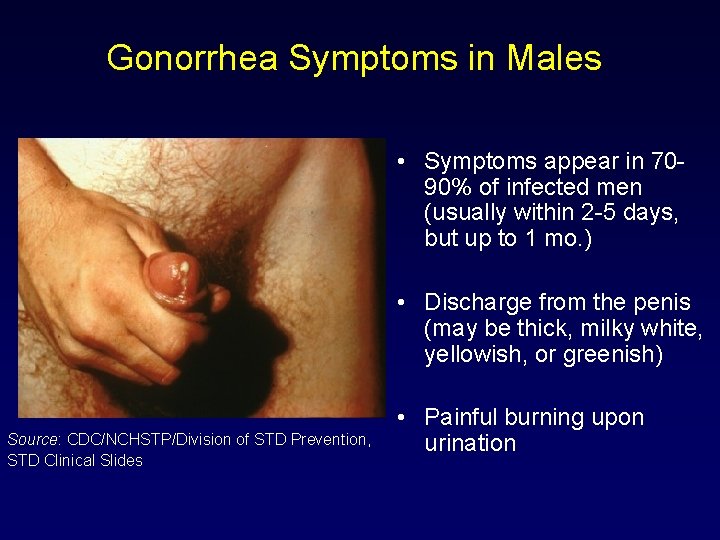 Gonorrhea Symptoms in Males • Symptoms appear in 7090% of infected men (usually within