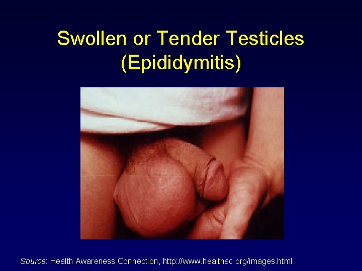 Swollen or Tender Testicles (Epididymitis) Source: Health Awareness Connection, http: //www. healthac. org/images. html