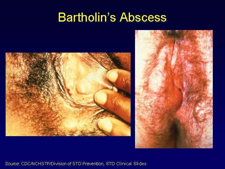 Bartholin’s Abscess Source: CDC/NCHSTP/Division of STD Prevention, STD Clinical Slides 