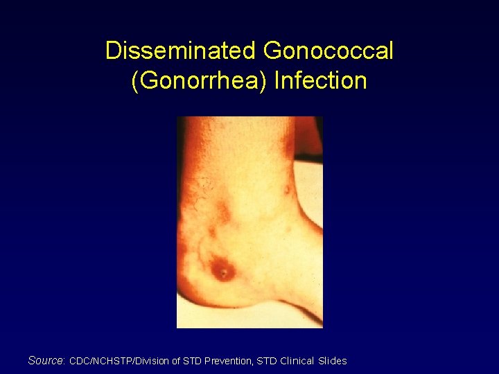 Disseminated Gonococcal (Gonorrhea) Infection Source: CDC/NCHSTP/Division of STD Prevention, STD Clinical Slides 