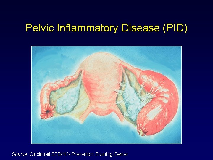 Pelvic Inflammatory Disease (PID) Source: Cincinnati STD/HIV Prevention Training Center 