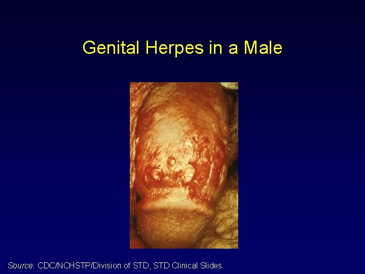 Genital Herpes in a Male Source: CDC/NCHSTP/Division of STD, STD Clinical Slides 