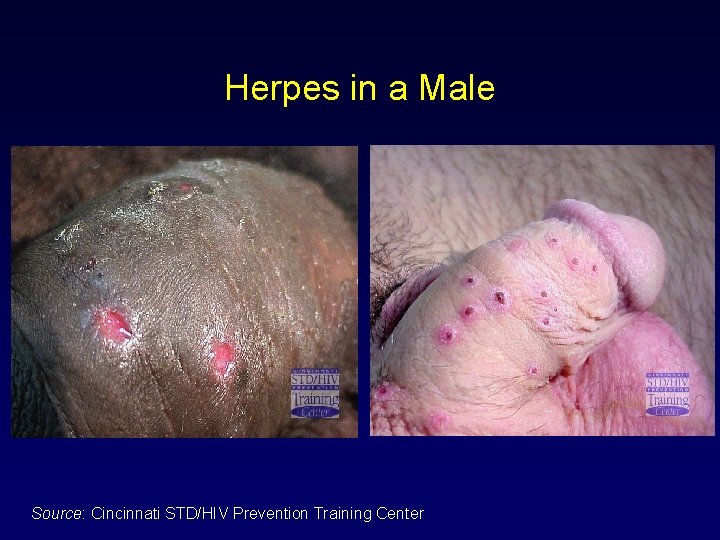 Herpes in a Male Source: Cincinnati STD/HIV Prevention Training Center 