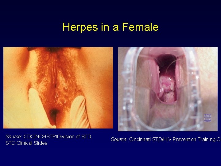 Herpes in a Female Source: CDC/NCHSTP/Division of STD, STD Clinical Slides Source: Cincinnati STD/HIV