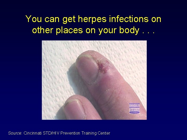 You can get herpes infections on other places on your body. . . Source: