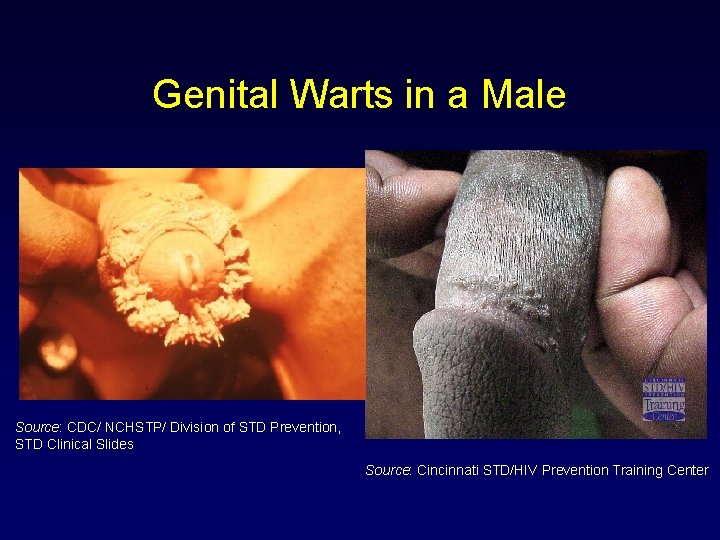 Genital Warts in a Male Source: CDC/ NCHSTP/ Division of STD Prevention, STD Clinical