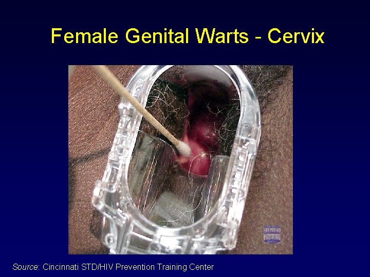 Female Genital Warts - Cervix Source: Cincinnati STD/HIV Prevention Training Center 