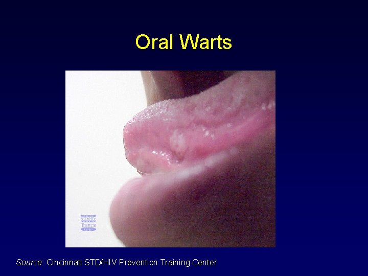 Oral Warts Source: Cincinnati STD/HIV Prevention Training Center 