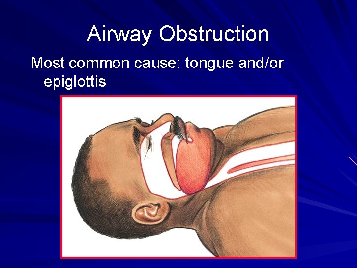 Airway Obstruction Most common cause: tongue and/or epiglottis 