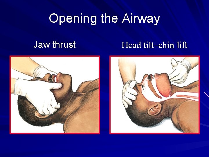 Opening the Airway Jaw thrust Head tilt–chin lift 