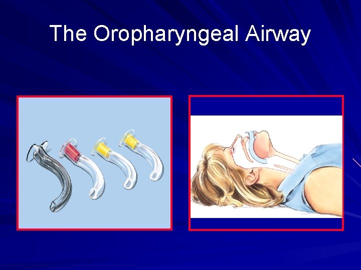 The Oropharyngeal Airway 