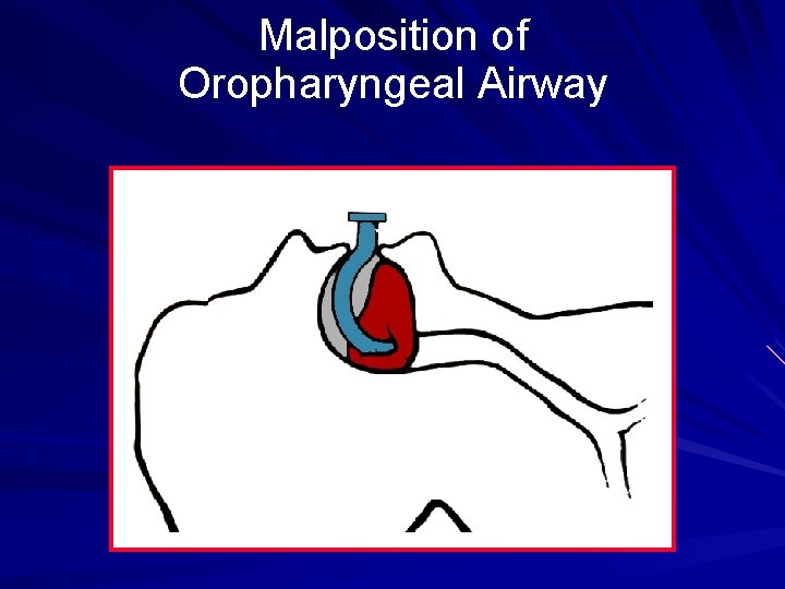 Malposition of Oropharyngeal Airway Too short 