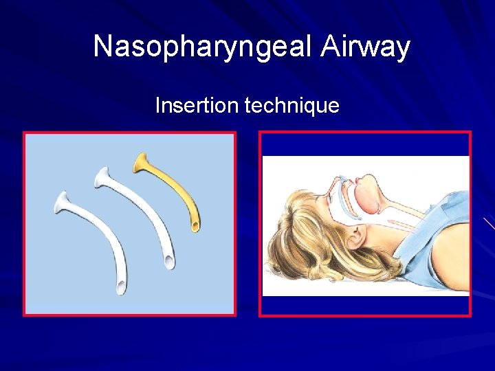 Nasopharyngeal Airway Insertion technique 