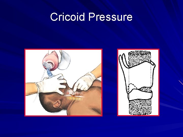 Cricoid Pressure Thyroid Cartilage Cricoid 