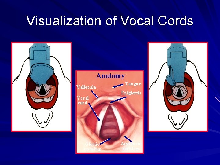 Visualization of Vocal Cords Anatomy Vallecula Vocal cord Glottic opening Tongue Epiglottis Arytenoid cartilage