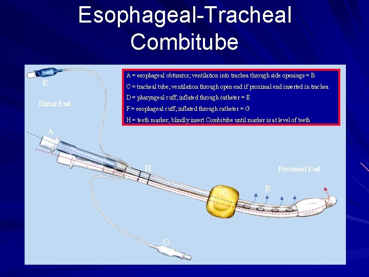 Esophageal-Tracheal Combitube A = esophageal obturator; ventilation into trachea through side openings = B