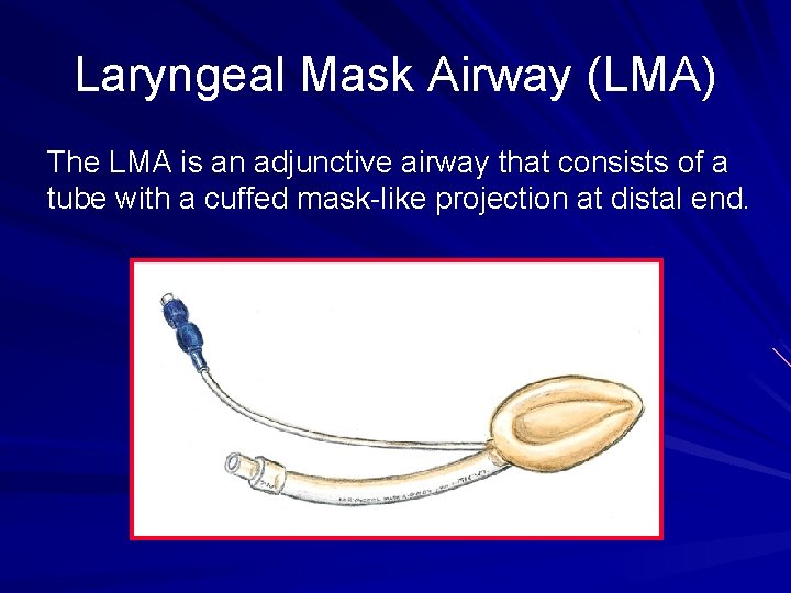 Laryngeal Mask Airway (LMA) The LMA is an adjunctive airway that consists of a