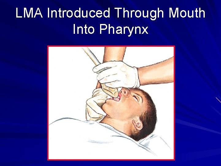 LMA Introduced Through Mouth Into Pharynx 