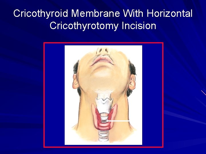 Cricothyroid Membrane With Horizontal Cricothyrotomy Incision 