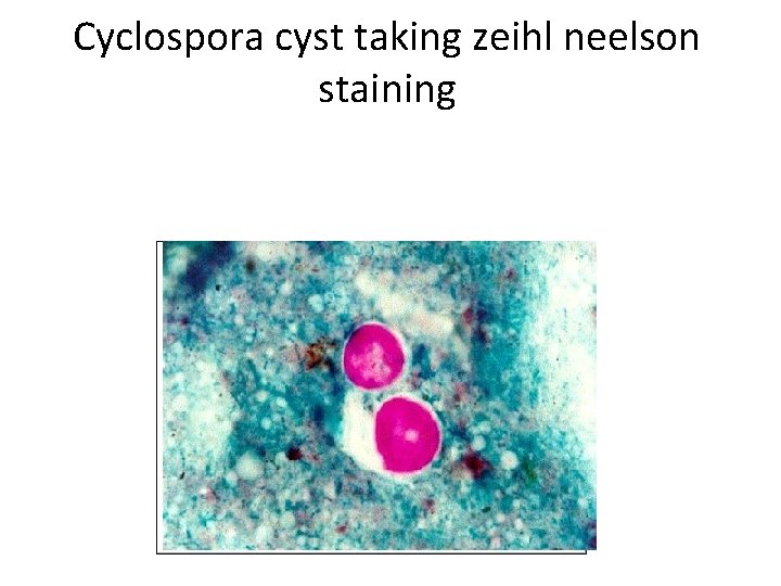 Cyclospora cyst taking zeihl neelson staining 