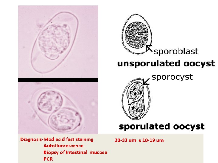 Diagnosis-Mod acid fast staining Autofluorescence Biopsy of Intestinal mucosa PCR 20 -33 um x