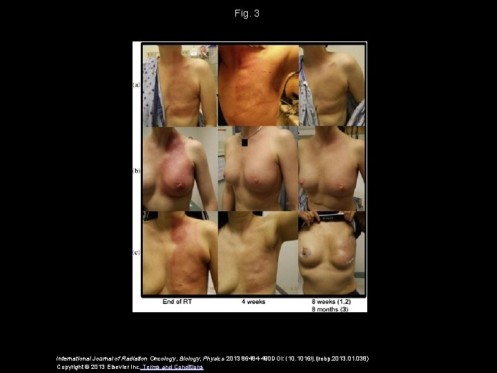 Fig. 3 International Journal of Radiation Oncology, Biology, Physics 2013 86484 -490 DOI: (10.