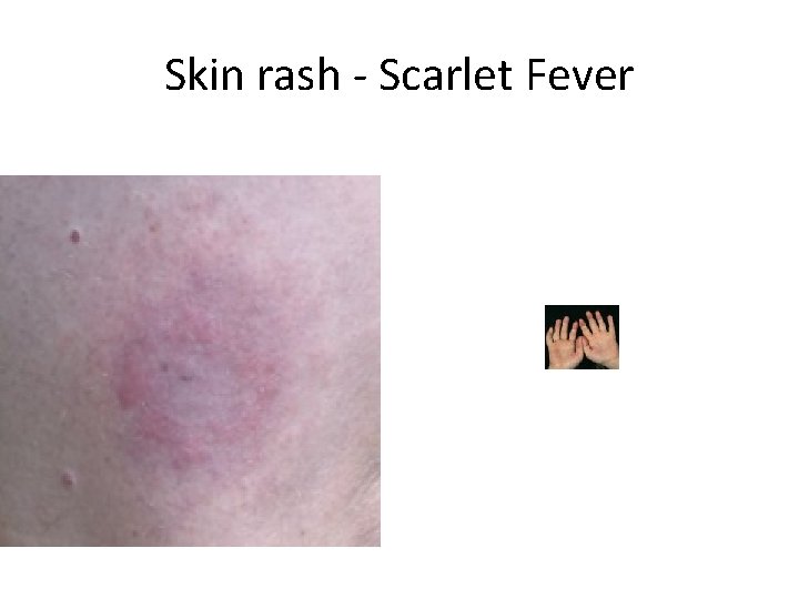 Skin rash - Scarlet Fever 