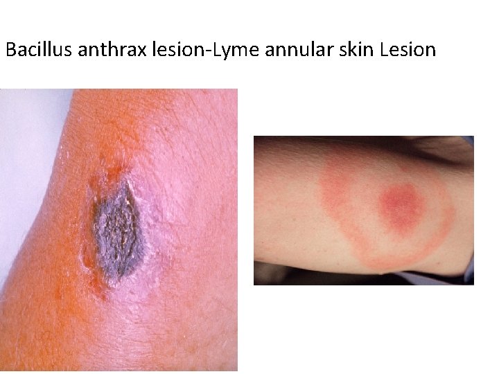 Bacillus anthrax lesion-Lyme annular skin Lesion 