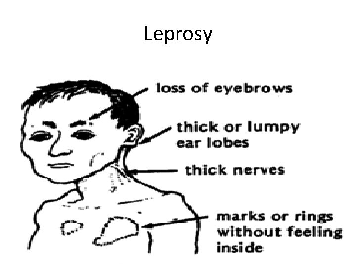 Leprosy 