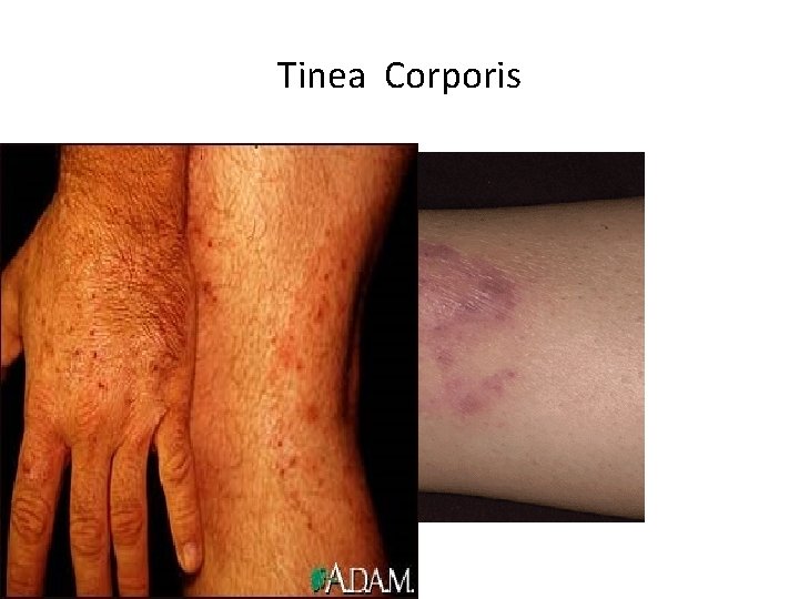Tinea Corporis 