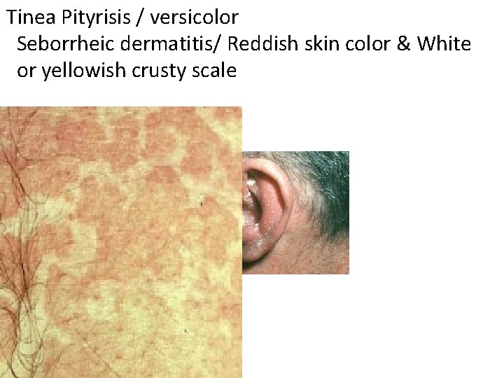 Tinea Pityrisis / versicolor Seborrheic dermatitis/ Reddish skin color & White or yellowish crusty