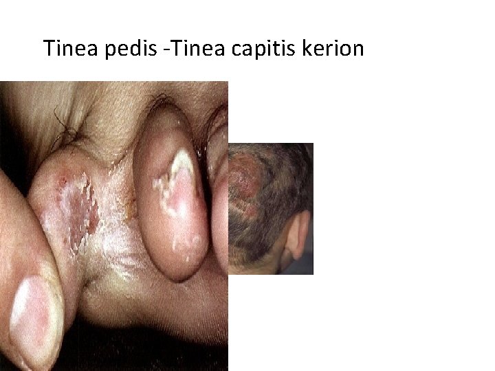  Tinea pedis -Tinea capitis kerion 