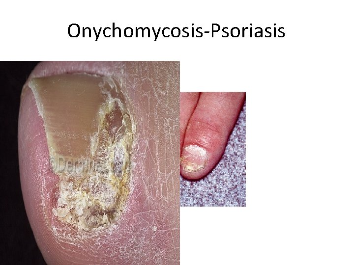 Onychomycosis-Psoriasis 