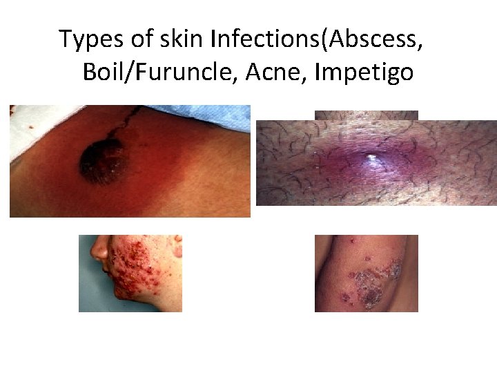 Types of skin Infections(Abscess, Boil/Furuncle, Acne, Impetigo 