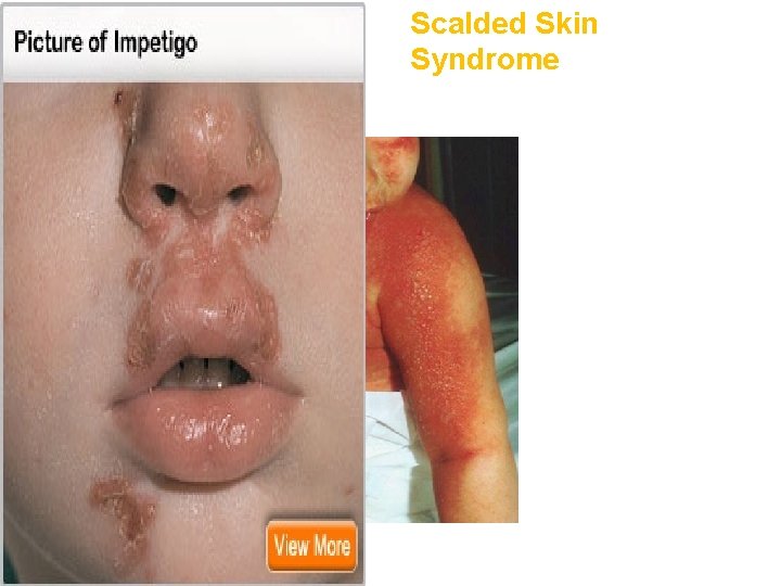 Scalded Skin Syndrome Scaled 