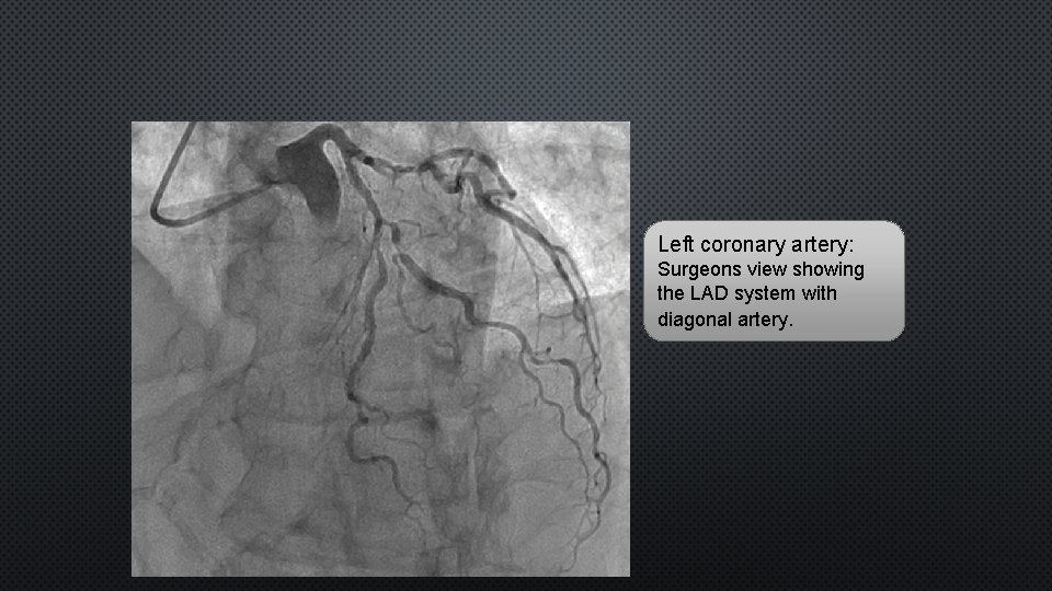 Left coronary artery: Surgeons view showing the LAD system with diagonal artery. 