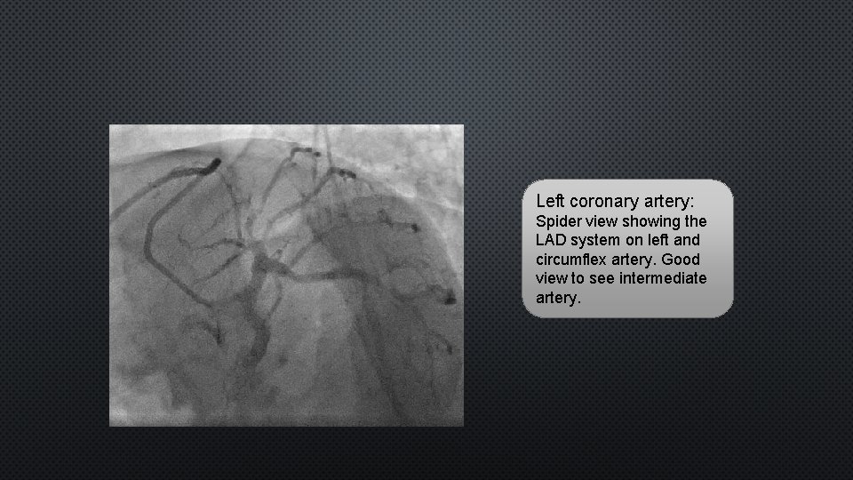 Left coronary artery: Spider view showing the LAD system on left and circumflex artery.