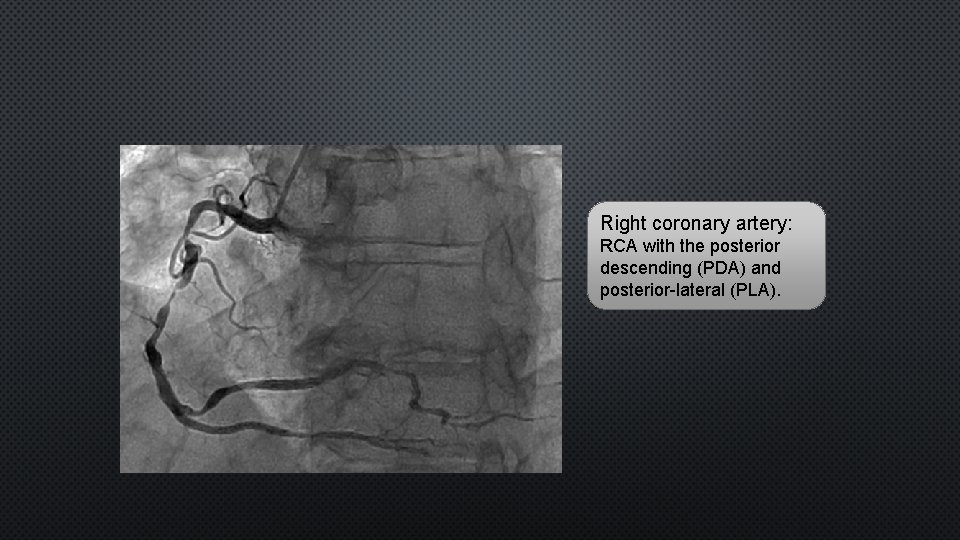 Right coronary artery: RCA with the posterior descending (PDA) and posterior-lateral (PLA). 