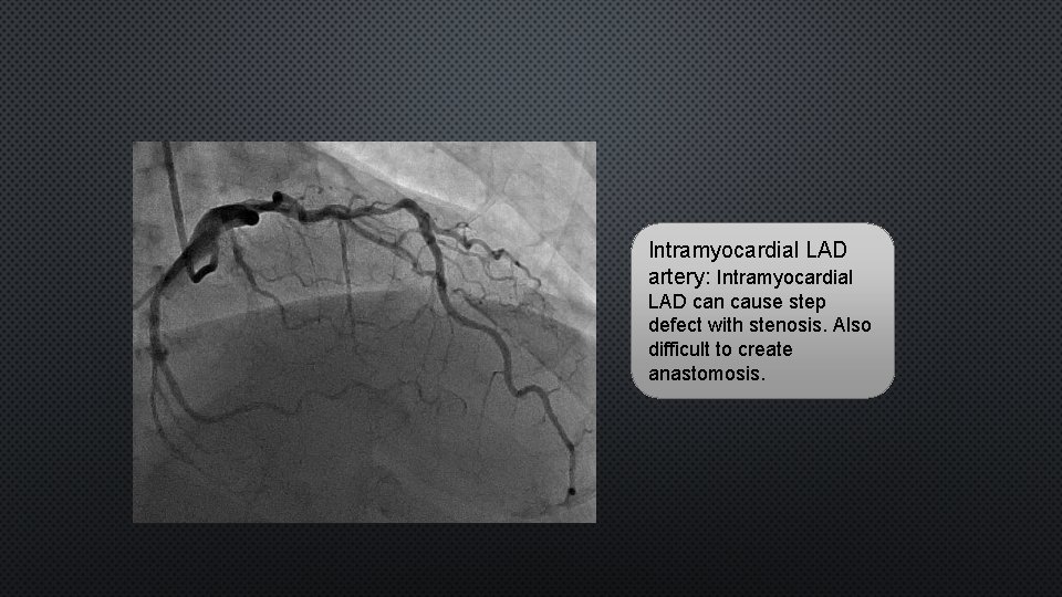 Intramyocardial LAD artery: Intramyocardial LAD can cause step defect with stenosis. Also difficult to