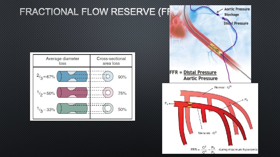 FRACTIONAL FLOW RESERVE (FFR) 