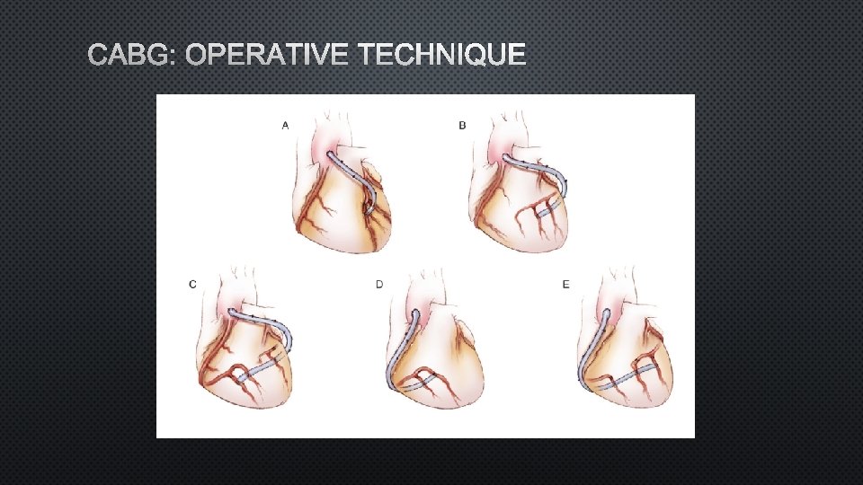 CABG: OPERATIVE TECHNIQUE 